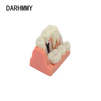 DARHMMY Dental Teach Implant Analysis Crown Bridge Removable Model Dental Demonstration Teeth Model Dental Implants Model